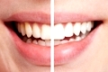 Vergleich von Zähnen vor und nach dem Bleichen beim Zahnarzt
